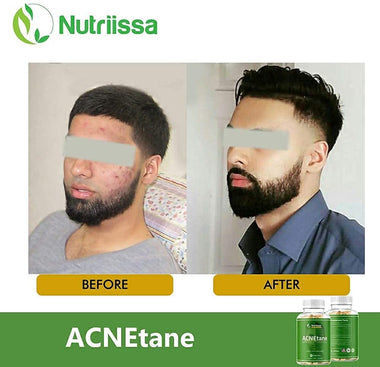 ACNEtane - Vitamin Supplement for Acne