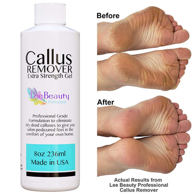Callus Remover gel for feet
